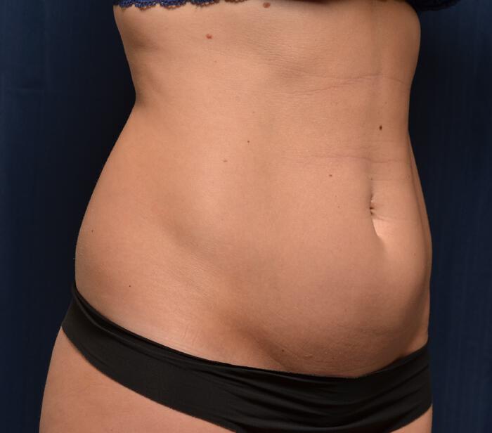 Liposuction Before & After Image