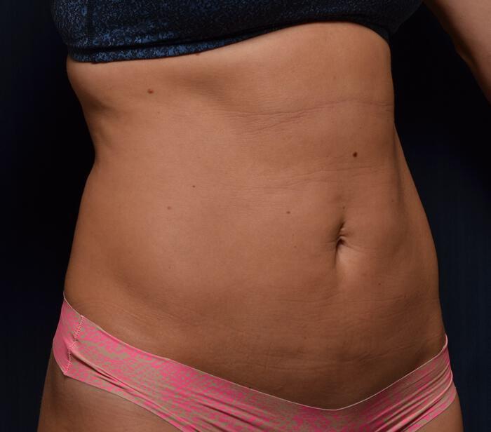 Liposuction Before & After Image