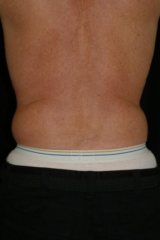 Liposuction Before & After Image