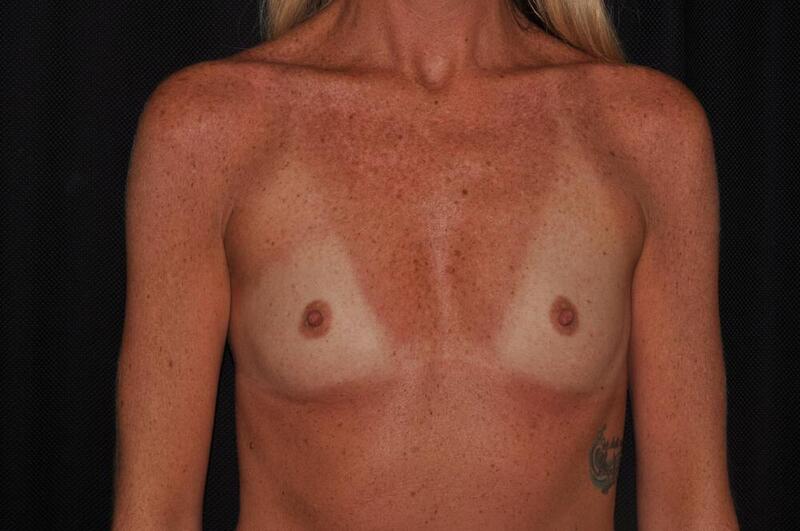 Breast Augmentation Before & After Image