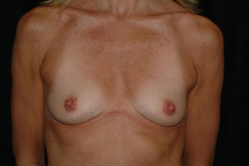 Breast Augmentation Before & After Image