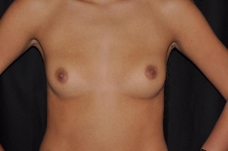 Breast Augmentation Before & After Image