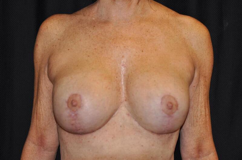 Breast Lift Augmentation Before & After Image