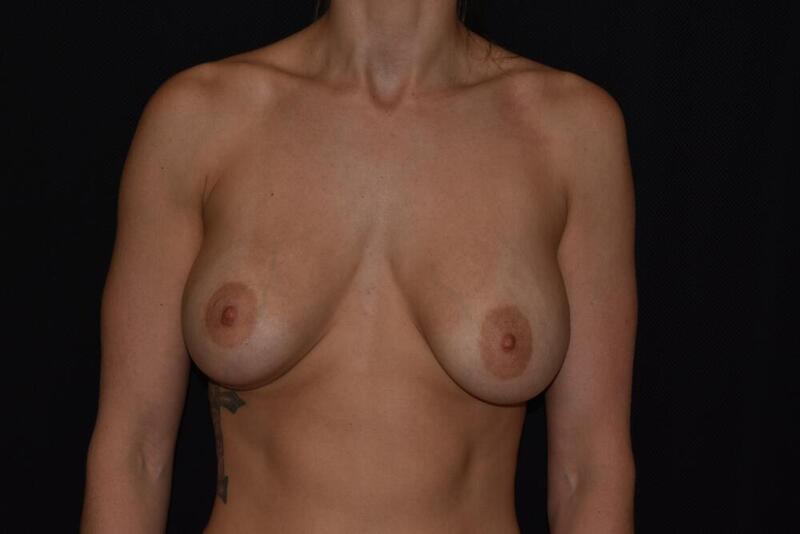 Breast Lift Augmentation Before & After Image