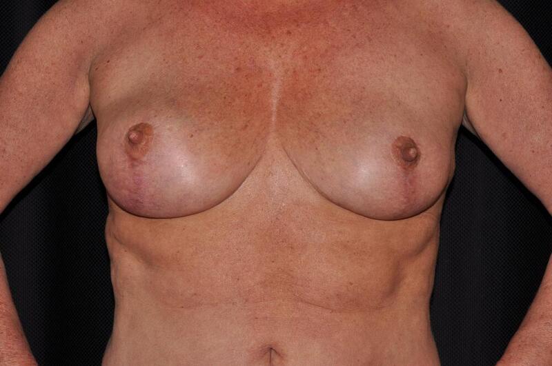 Breast Reduction Before & After Image