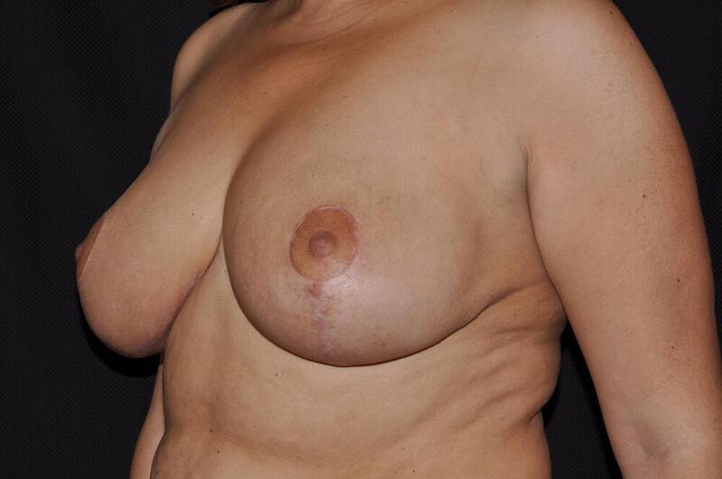 Breast Reduction Before & After Image