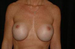 Breast Revision Before & After Image