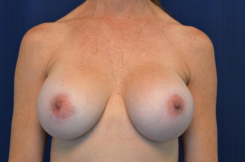 Breast Revision Before & After Image