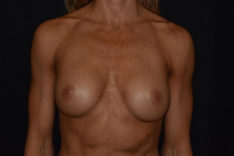 Breast Revision Before & After Image