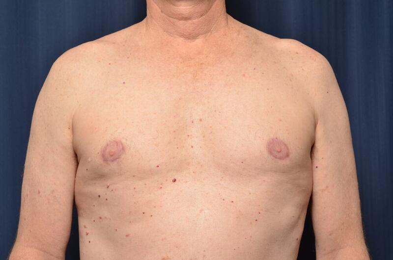 Gynecomastia Before & After Image