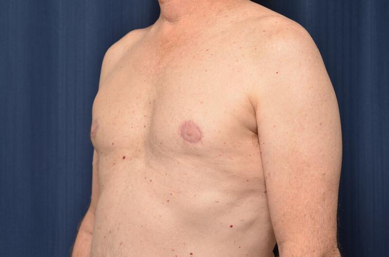 Gynecomastia Before & After Image