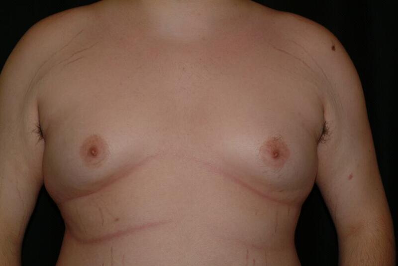 Gynecomastia Before & After Image