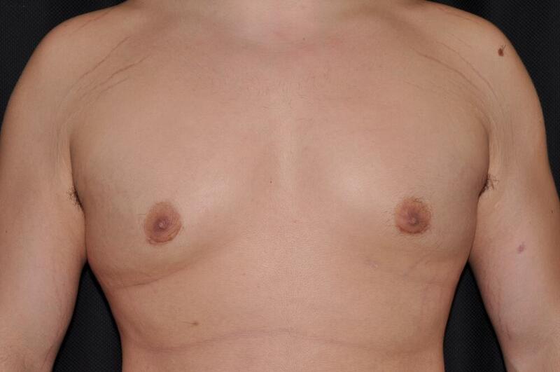 Gynecomastia Before & After Image