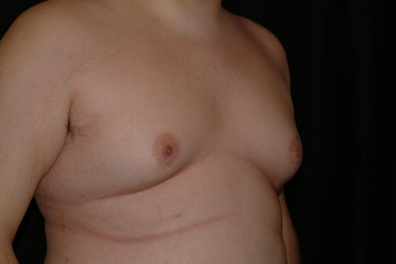 Gynecomastia Before & After Image