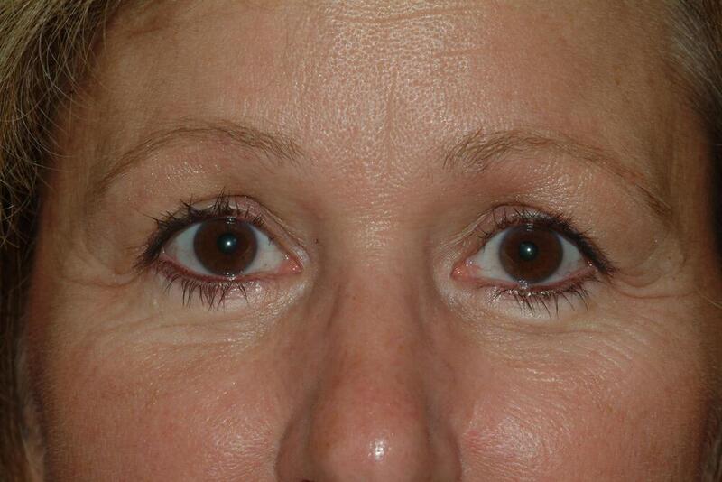 Blepharoplasty Before & After Image