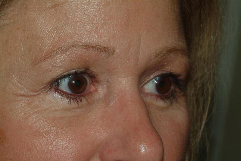 Blepharoplasty Before & After Image