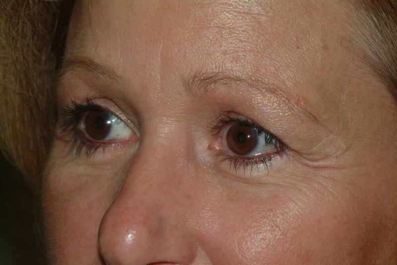 Blepharoplasty Before & After Image