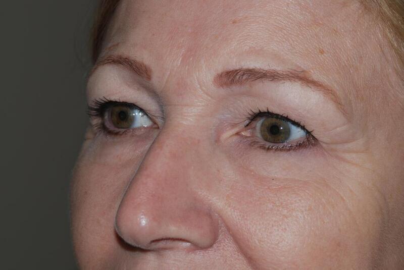 Blepharoplasty Before & After Image