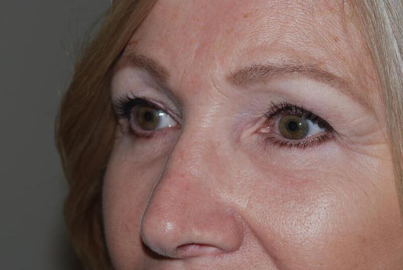 Blepharoplasty Before & After Image