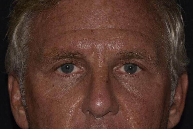 Blepharoplasty Before & After Image