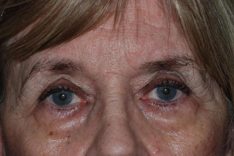 Blepharoplasty Before & After Image