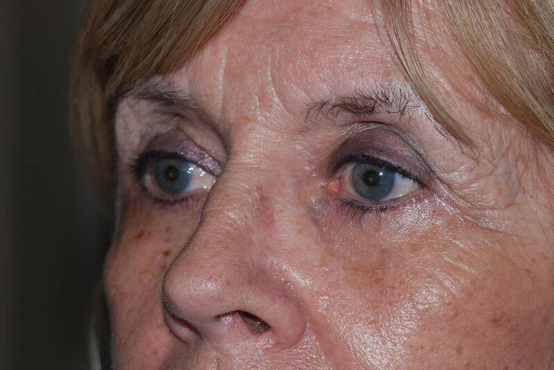 Blepharoplasty Before & After Image