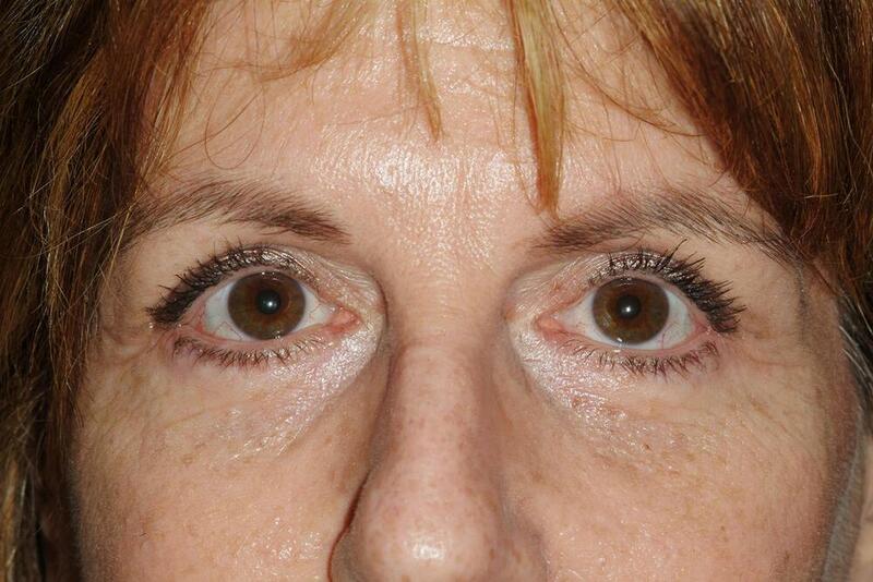 Blepharoplasty Before & After Image