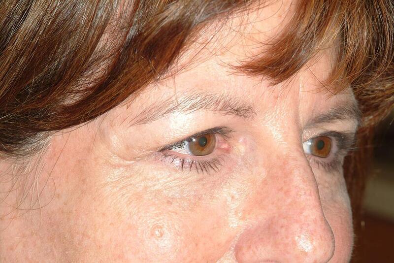 Blepharoplasty Before & After Image