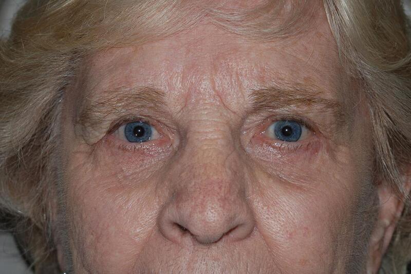 Blepharoplasty Before & After Image