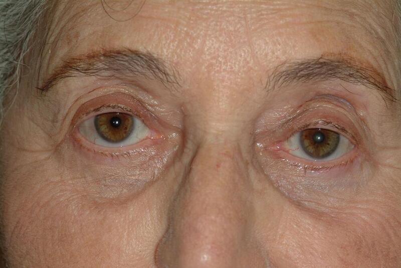 Blepharoplasty Before & After Image