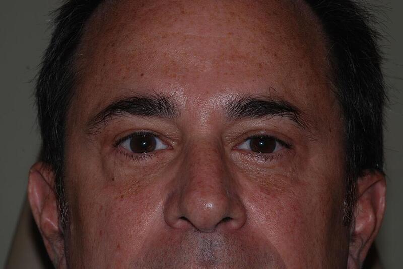 Blepharoplasty Before & After Image