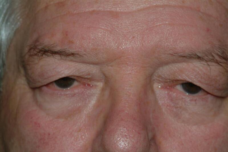 Blepharoplasty Before & After Image