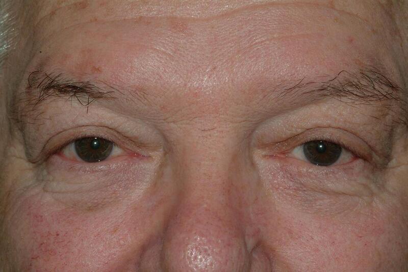 Blepharoplasty Before & After Image