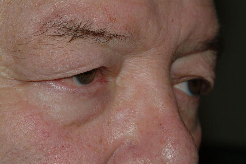 Blepharoplasty Before & After Image