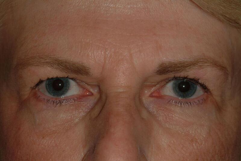 Blepharoplasty Before & After Image