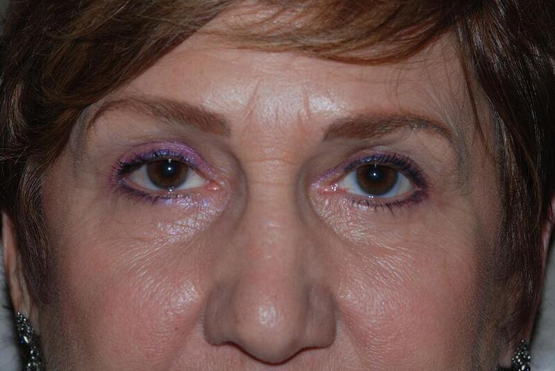 Blepharoplasty Before & After Image