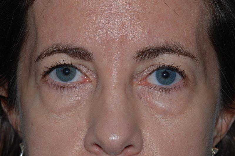 Blepharoplasty Before & After Image