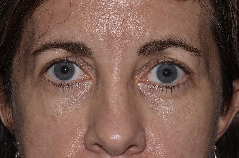 Blepharoplasty Before & After Image