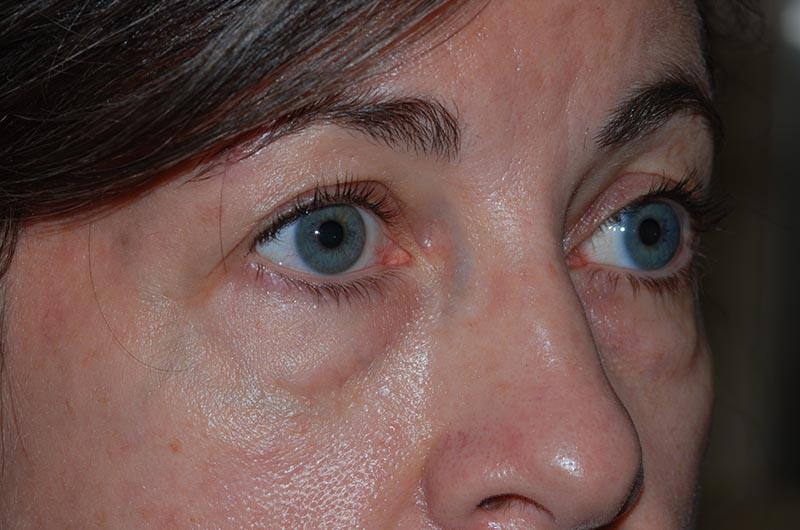 Blepharoplasty Before & After Image