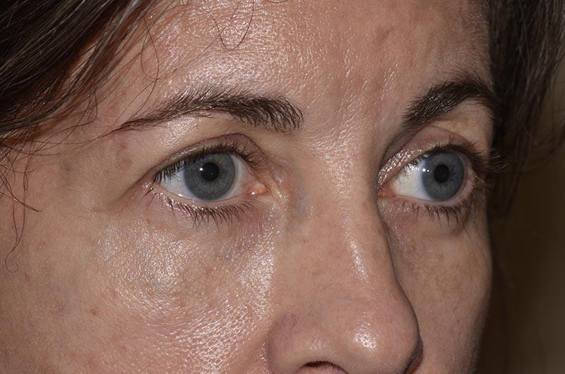 Blepharoplasty Before & After Image