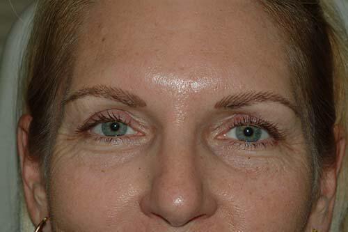 Blepharoplasty Before & After Image