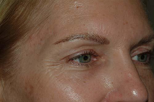 Blepharoplasty Before & After Image