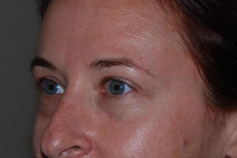 Blepharoplasty Before & After Image