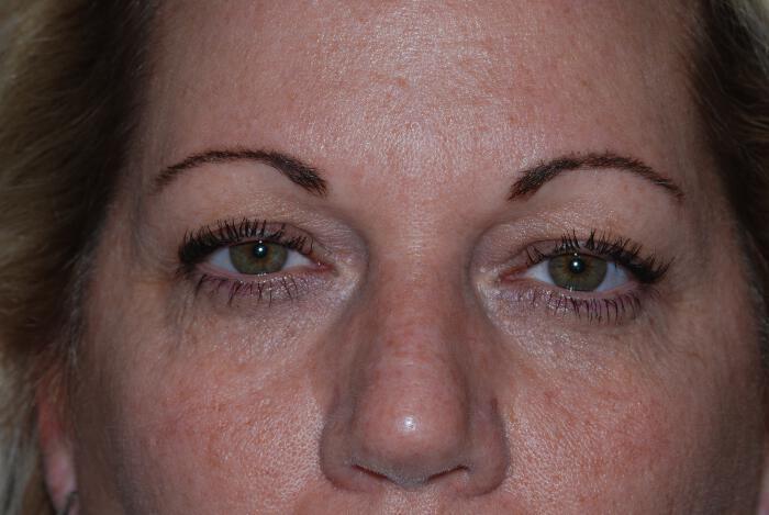 Blepharoplasty Before & After Image