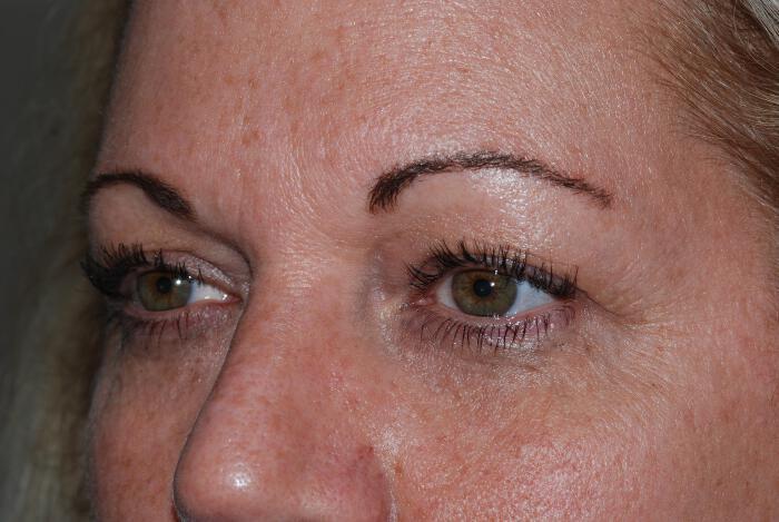 Blepharoplasty Before & After Image