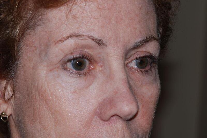 Blepharoplasty Before & After Image