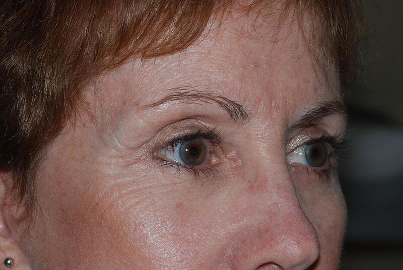 Blepharoplasty Before & After Image