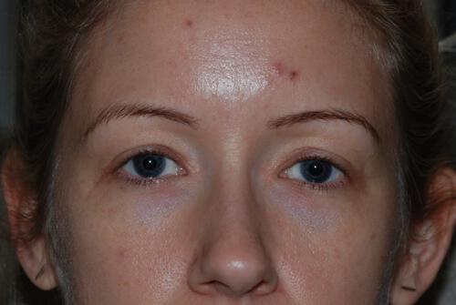 Blepharoplasty Before & After Image