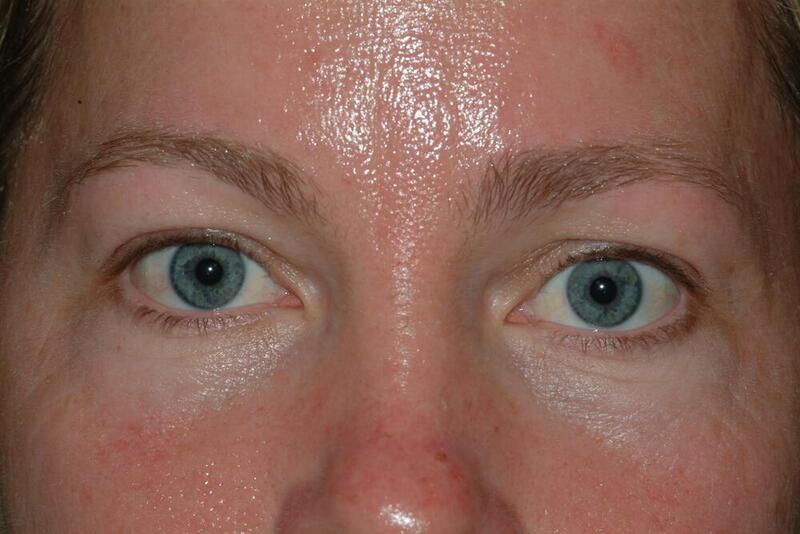 Blepharoplasty Before & After Image