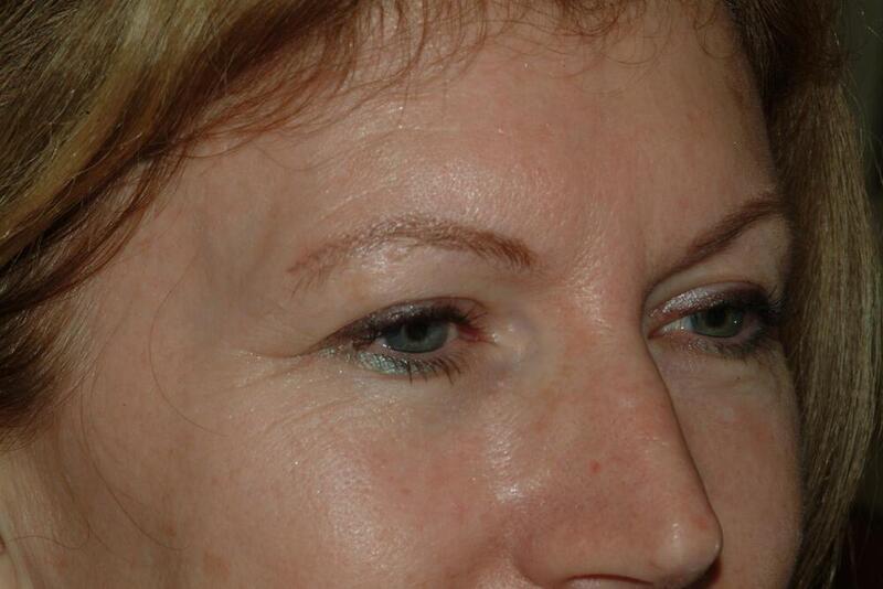 Blepharoplasty Before & After Image